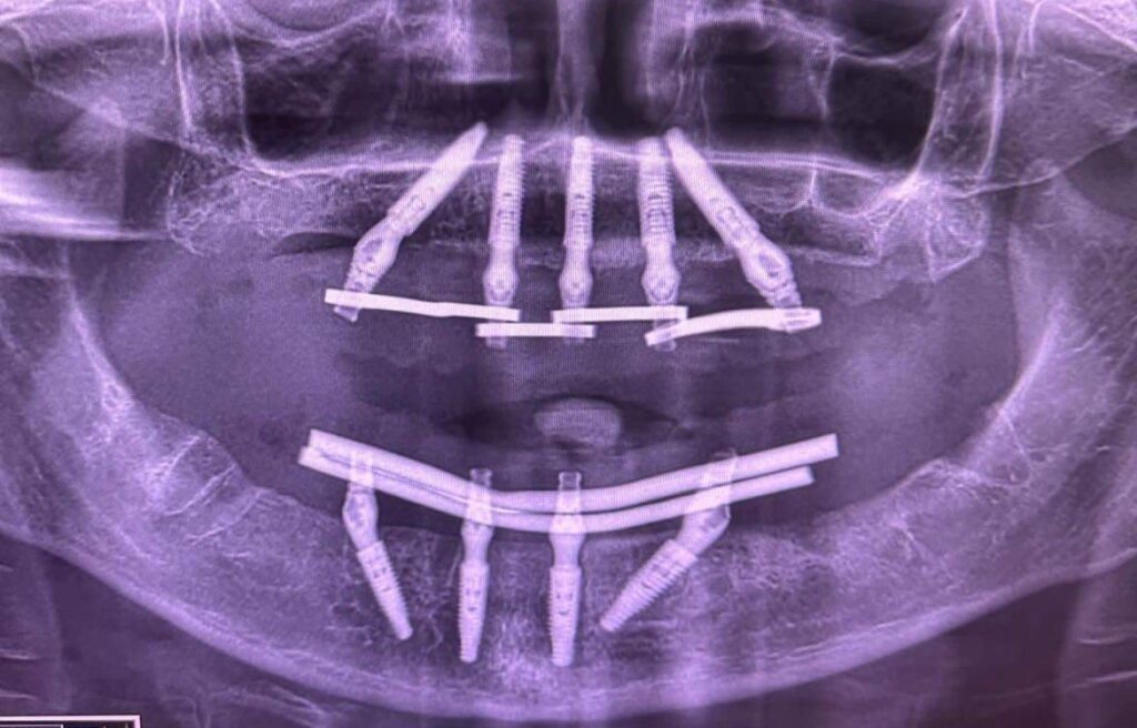All-on-x röntgenvaade