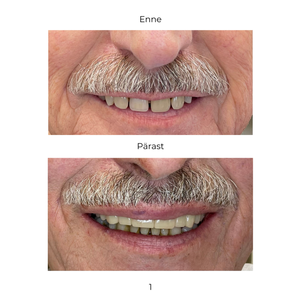 All-on-4/all-on-x proteetiline lahendus andis patsiendile uue ilusa naeratuse.