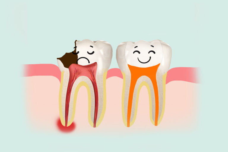 Juureravi aitab päästa ka põletikulise hamba.